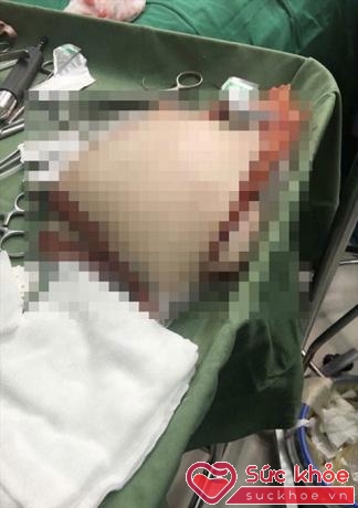 Phần mỡ đã được phẫu thuật cắt từ bụng nữ diễn viên Thủy Tiên.