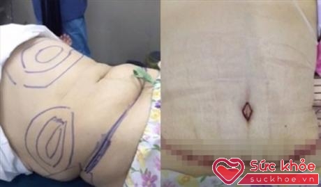 Sau phẫu thuật, Thủy Tiên tự tin chụp ảnh eo thon khoe trên facebook.