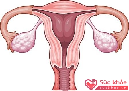 Viêm cổ tử cung nguy hiểm đến khả năng sinh sản ở phụ nữ