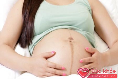 Đường nigra rõ khi mang thai