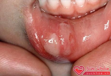 Nếu trên môi có các vết sưng loét lớn, hình tròn hoặc hình bầu dục thì có thể là dấu hiệu của bệnh giang mai ở giai đoạn 1 