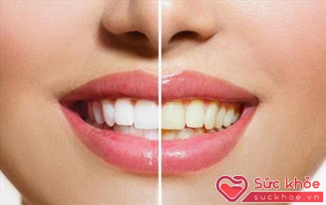Suy giảm hormone stress có thể khiến răng bạn trông như trắng hơn.