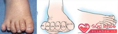 Phẫu thuật dị tật là cách tốt nhất để loại bỏ ngón thừa (Ảnh minh họa: Internet)