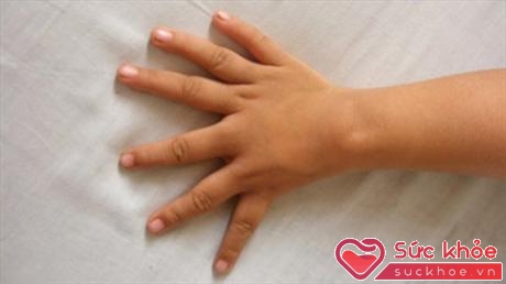 Dị tật thừa ngón gây cản trở thực hiện chức năng của bàn tay, bàn chân (Ảnh minh họa: Internet)