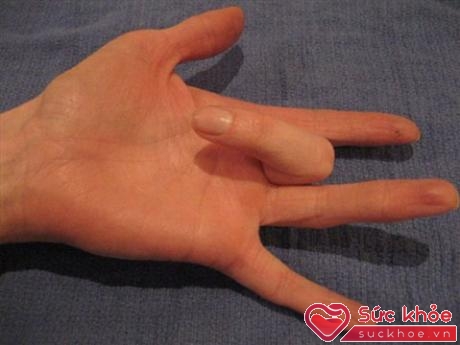 Co cứng ngón tay là tình trạng đau đớn, các ngón tay bị mắc kẹt ở vị trí cong queo.
