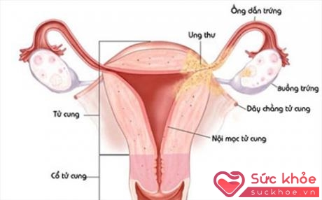 Khi lớp lót bên trong tử cung bắt đầu phát triển ra khỏi vị trí bình thường của nó thì được gọi là nội mạc tử cung