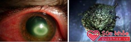 Ký sinh trùng Acanthamoeba trong mắt.