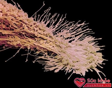 Tế bào ung thư âm đạo được phóng lớn dưới kính hiển vi (Ảnh minh họa: Internet)
