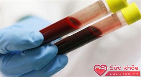 Kết quả xét nghiệm máu trong 'ngày đèn đỏ' còn tùy thuộc vào hình thức xét nghiệm mà bạn thực hiện