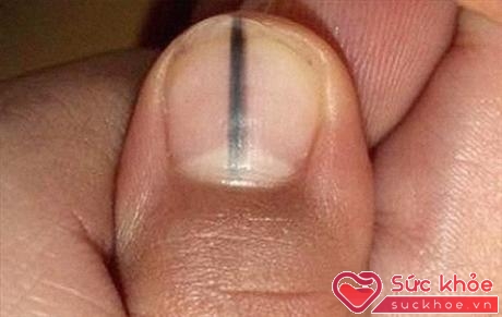 Vết sọc đen trên móng tay có thể nghiêm trọng hơn bạn nghĩ rất nhiều.
