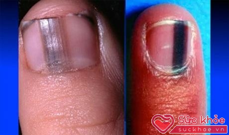 Nail melanoma được gọi là u hắc tố dưới móng, u ác tính dưới da, hay còn gọi là ung thư da.