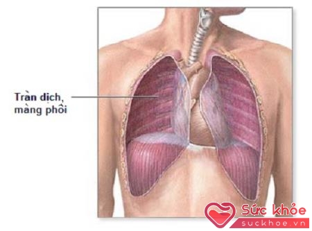 Viêm phổi do vi khuẩn mycoplasma gây ra làm con người tức ngực, tim đập nhanh
