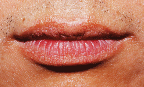 Nếu trên môi bạn xuất hiện chấm màu trắng, nhiều khả năng có kí sinh trùng trong đại tràng