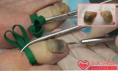 Quá trình cắt bỏ 2 móng chân cái cho bệnh nhân