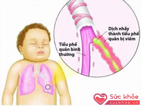 Hình ảnh viêm tiểu phế quản ở trẻ (Ảnh: Internet)