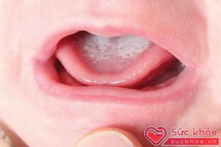 Lưỡi bé bị đóng trắng có thể là dấu hiệu của việc bé bị nấm. (Ảnh minh họa)