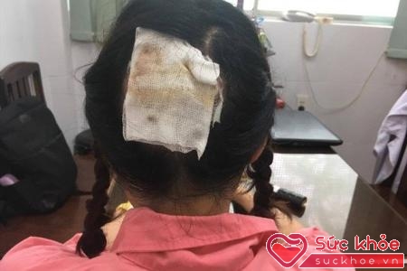 Các bác sĩ khoa Phỏng – Phẫu thuật tạo hình, Bệnh viện Chợ Rẫy cho biết, trong năm 2017 đến nay, đã có 6 bệnh nhân phải nhập viện vì bỏng vùng da đầu sau khi đi làm tóc. (Ảnh: Lao động)