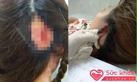 Chị T. mất da đầu, một chị hoại tử vành tai khi đi làm tóc.(Ảnh: Dân trí)