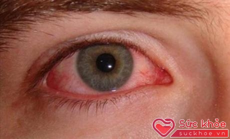 Đau mắt đỏ là bệnh thường gặp tại các bể bơi công cộng. Ảnh minh họa