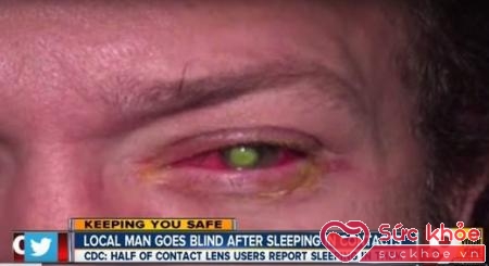 Chad Groeschen (39 tuổi) bị mù do ngủ thiếp đi khi mắt vẫn còn đeo kính áp tròng