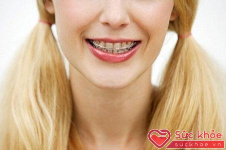 Đeo niềng răng sẽ giúp bạn có hàm răng đều và đẹp hơn