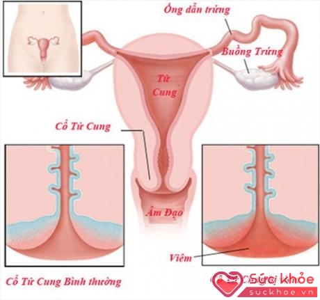 Phì đại cổ tử cung là một trong những bệnh phụ khoa thường gặp, chủ yếu do viêm cổ tử cung mãn tính gây ra