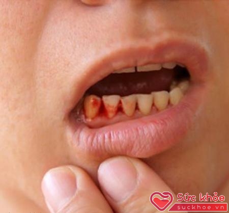 Chảy máu chân răng có thể được điều trị tại nhà bằng những phương đơn giản