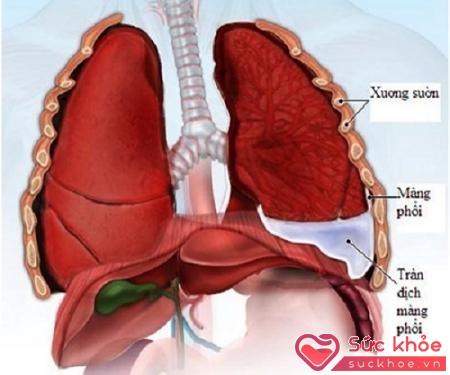 Tràn máu màng phổi là tình trạng sức khỏe vô cùng nguy hiểm