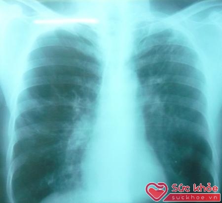 Bệnh nhân bị tràn khí dưới da có thể biểu hiện của suy hô hấp