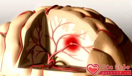 Vỡ mạch máu não là hiện tượng phình mạch máu