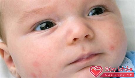 Trẻ sơ sinh có làn da nhạy cảm nên rất dễ bị phát ban, nổi mụn (Ảnh: Internet)