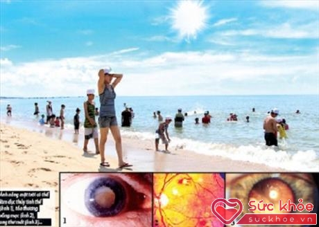Ánh nắng mặt trời có thể làm tăng nguy cơ hình thành một số loại ung thư mắt.