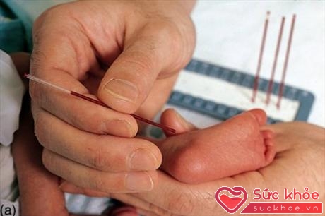 Sàng lọc sơ sinh có vai trò quan trọng phát triển kịp thời nhiều bệnh ở trẻ nhỏ