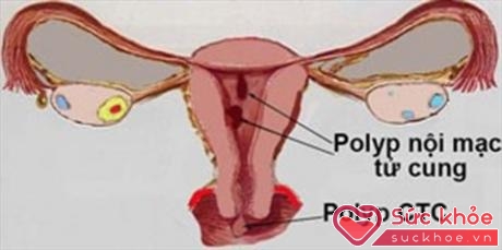Polyp tử cung có thể xuất hiện trở lại, vì vậy, bạn cần nắm được triệu chứng bệnh để có thể phát hiện và điều trị 