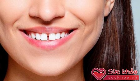 Đặc điểm của răng thưa là răng trên rộng dưới hẹp, kích cỡ không đều nhau