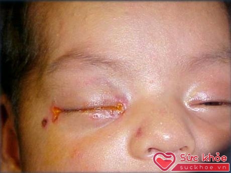Bệnh lậu truyền cho trẻ sơ sinh có thể gây mù mắt