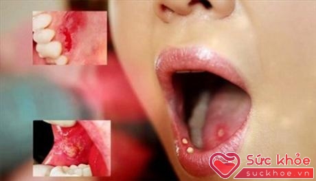 Loét miệng kéo dài có thể là triệu chứng của ung thư miệng