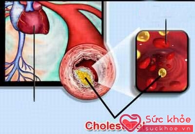 Thuốc statin không những có tác dụng làm giảm cholesterol máu