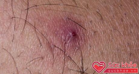 Biểu hiện bệnh viêm nang lông