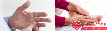 Tê bì tay chân – biểu hiện của biến chứng thần kinh do đái tháo đường