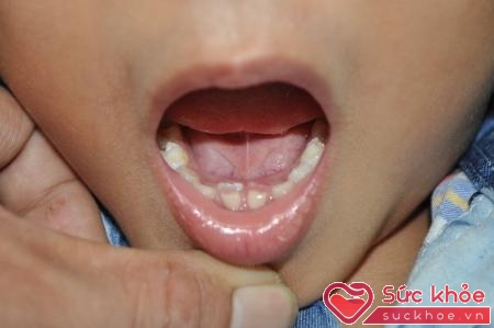 Cha mẹ nên thường xuyên kiểm tra răng, miệng cho bé. (Ảnh Intermet)