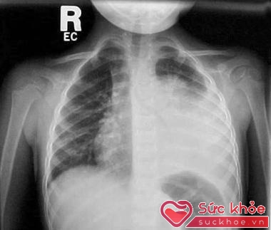 Phim X-quang lồng ngực ở một bệnh nhi 3 tuổi bị viêm mủ màng phổi với biểu hiện sốt và khó thở phát hiện đám mờ lớn ở phổi trái, góc sườn hoành trái bị tù. (Ảnh BS cung cấp)