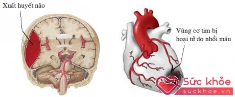 Đột ngột dừng thuốc trị tăng huyết áp có thể gây tai biến nghiêm trọng ở não, tim