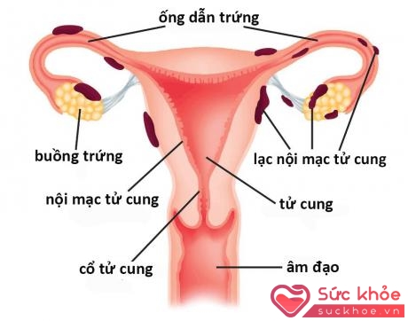 Lạc nội mạc tử cung xuất hiện ở ống dẫn trứng, buồng trứng mà không bám vào mặt trong tử cung.
