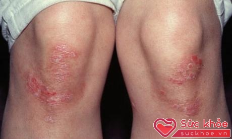 Bệnh vẩy nến là một rối loạn thể chất phức tạp, gây ra những đốm có vẩy đỏ trên da