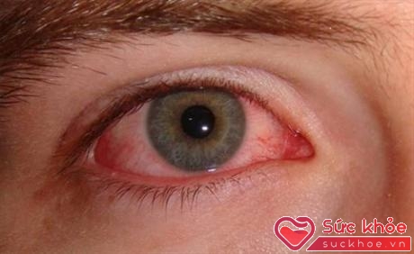 Đau mắt đỏ là bệnh viêm kết mạc cấp do adeno vi-rút 