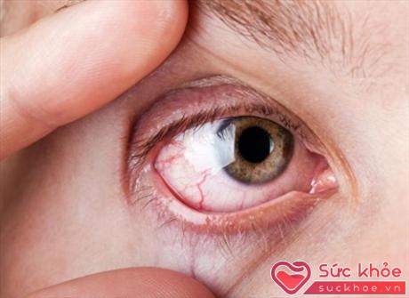 Đa phần bệnh đau mắt đỏ sẽ tự khỏi sau khoảng 7 đến 14 ngày