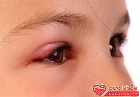 Khi bị đau mắt đỏ, không nên đắp các loại lá để tránh biến chứng