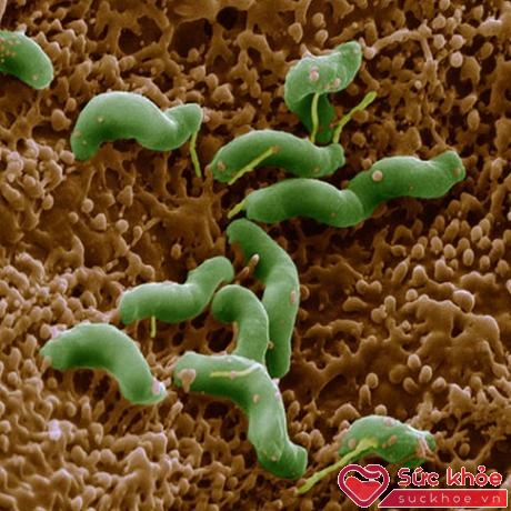 95% số ca viêm dạ dày mãn tính là do vi khuẩn Helicobacter Pylori (Hp) gây nên. 