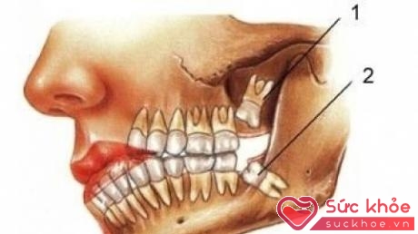 Nhiều khi răng khôn bị kẹt hay lèn trong xương hàm, hay không mọc được.